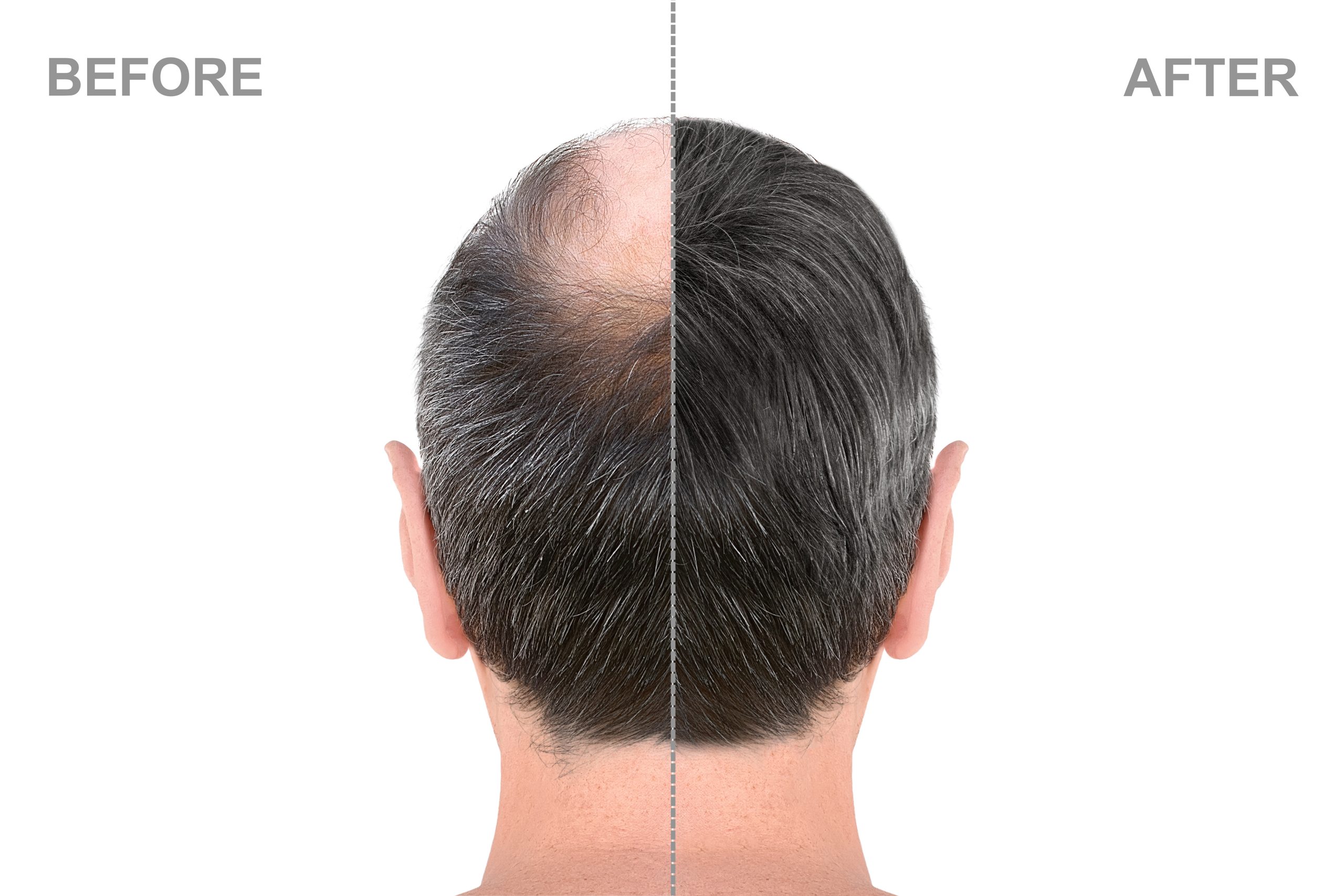 Avant-Aprés Greffe de Cheveux Vertex