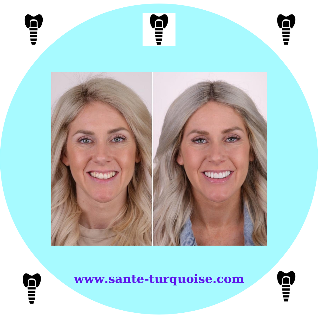 Implants that feel natural, smiles that last forever.