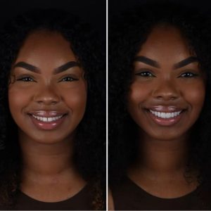 Dental implant before after international patient – Turkuaz Clinic Istanbul