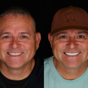 Zirconium crown smile makeover before and after – international patient Turkey
