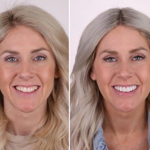 Full mouth dental restoration before after – dental implants and zirconium crowns