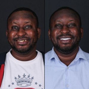 Before after dental treatment Turkey – natural smile results for international patients